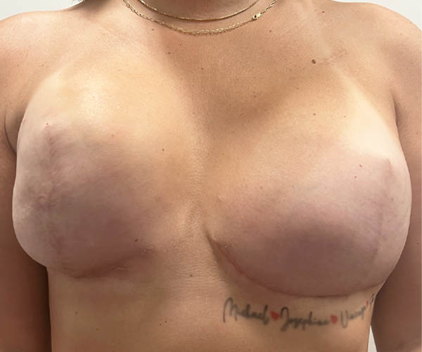 Nipple-Areola Complex (NAC) case #10109