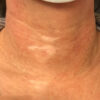 Scar/Skin Discoloration & Stretch Marks case #10174