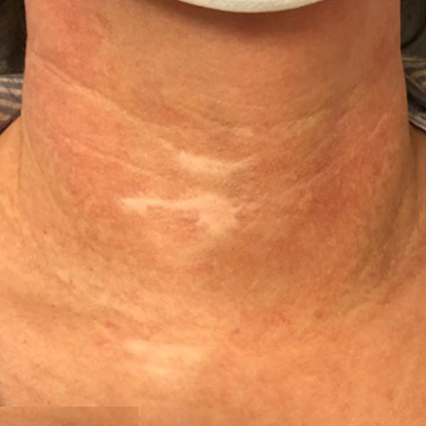 Scar/Skin Discoloration case #10174