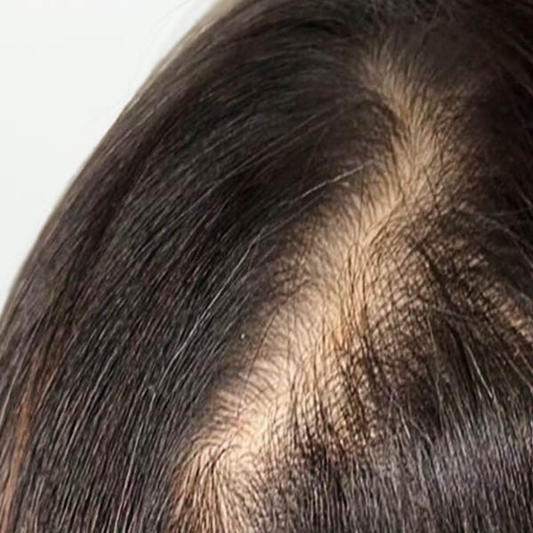 Scalp Micropigmentation case #10070