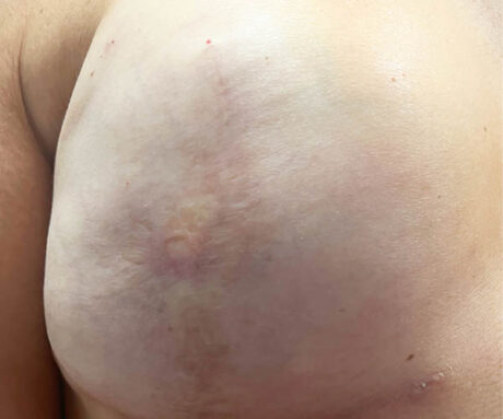 Nipple-Areola Complex (NAC) case #10104