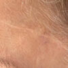 Scar/Skin Discoloration & Stretch Marks case #10171