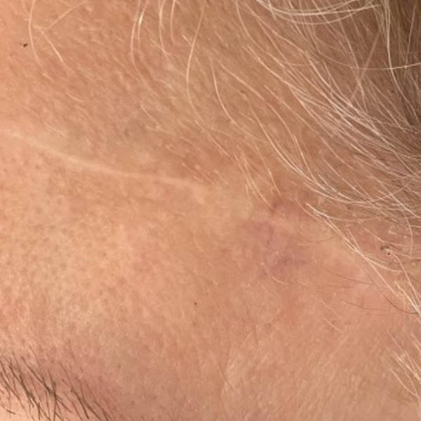 Scar/Skin Discoloration case #10171