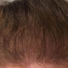 Scalp Micropigmentation case #10073