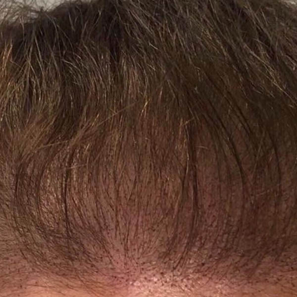 Scalp Micropigmentation case #10073