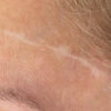 Scar/Skin Discoloration & Stretch Marks case #10171
