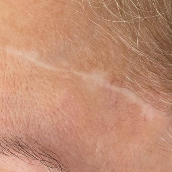 Scar/Skin Discoloration case #10171