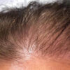 Scalp Micropigmentation case #10073