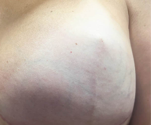 Nipple-Areola Complex (NAC) case #10104