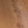 Scar/Skin Discoloration & Stretch Marks case #10168