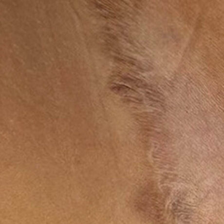 Scar/Skin Discoloration & Stretch Marks case #10168