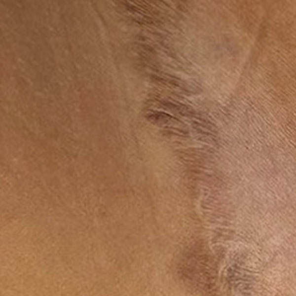 Scar/Skin Discoloration & Stretch Marks case #10168