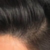 Scalp Micropigmentation case #10076