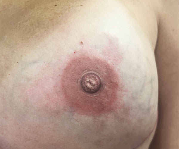 Nipple-Areola Complex (NAC) case #10104
