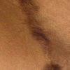 Scar/Skin Discoloration & Stretch Marks case #10168