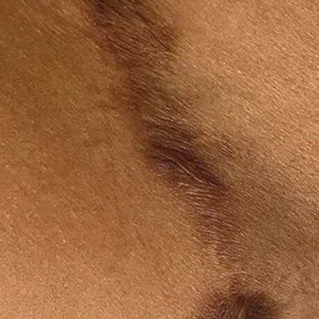 Scar/Skin Discoloration & Stretch Marks case #10168