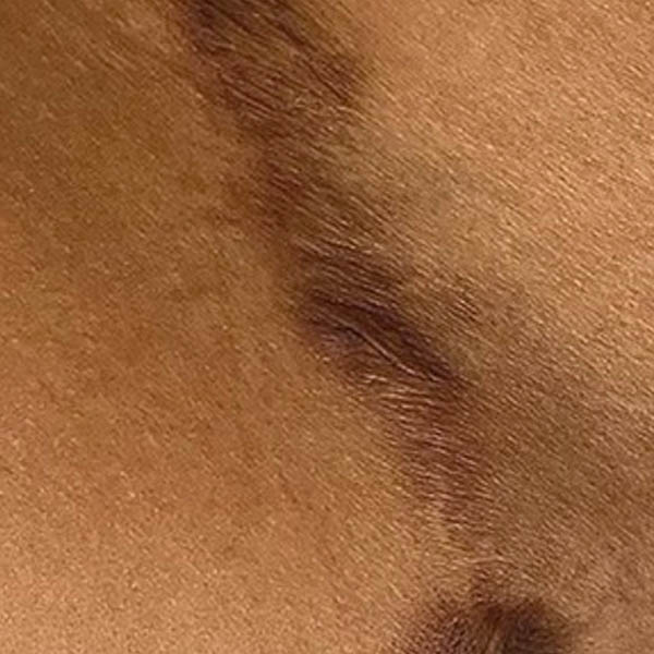 Scar/Skin Discoloration & Stretch Marks case #10168