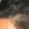 Scalp Micropigmentation case #10076