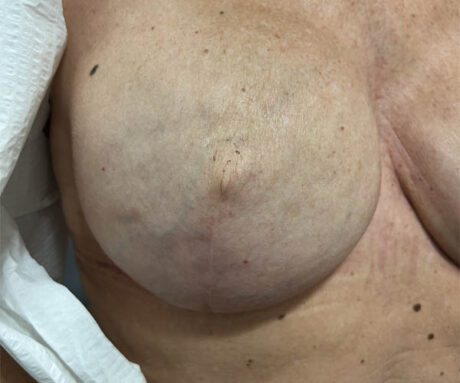 Nipple-Areola Complex (NAC) case #10099