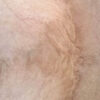 Scar/Skin Discoloration & Stretch Marks case #10165