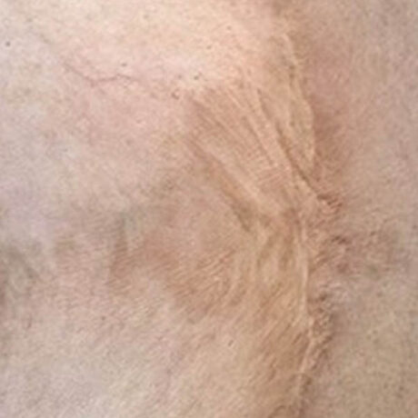 Scar/Skin Discoloration & Stretch Marks case #10165