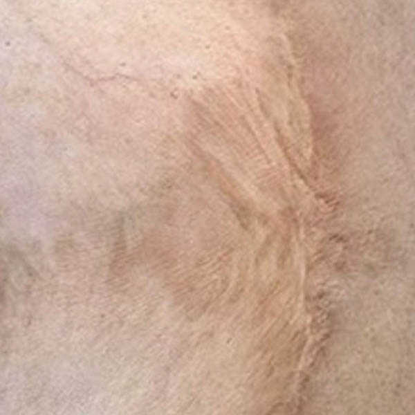 Scar/Skin Discoloration & Stretch Marks case #10165