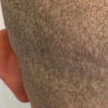 Scalp Micropigmentation case #10079