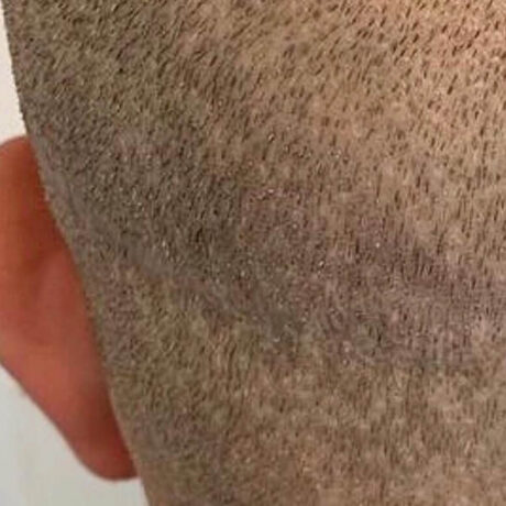 Scalp Micropigmentation case #10079