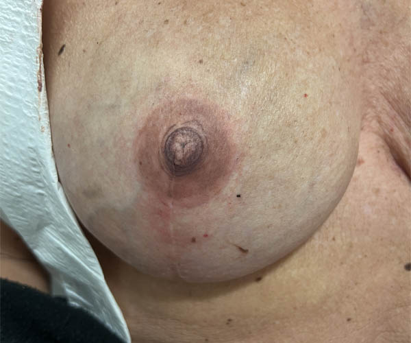 Nipple-Areola Complex (NAC) case #10099