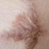 Scar/Skin Discoloration & Stretch Marks case #10165
