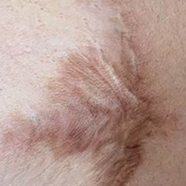 Scar/Skin Discoloration & Stretch Marks case #10165