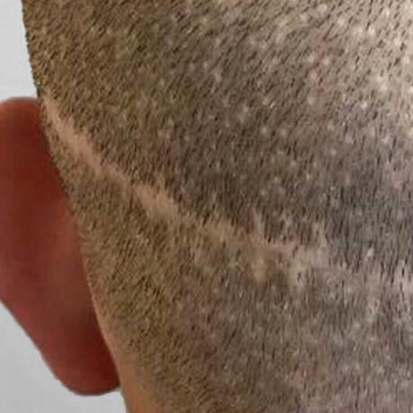 Scalp Micropigmentation case #10079