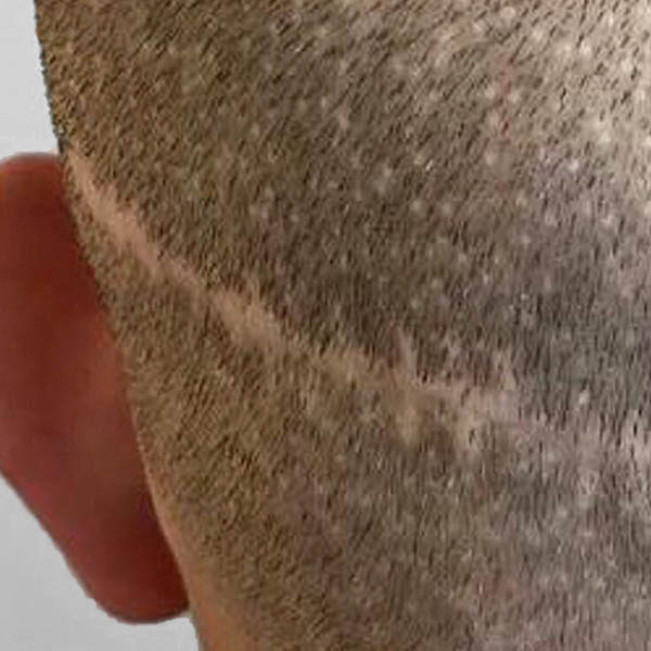 Scalp Micropigmentation case #10079