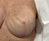 Nipple-Areola Complex (NAC) case #10099