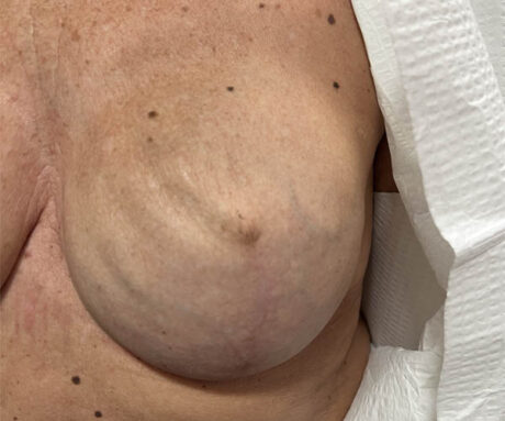 Nipple-Areola Complex (NAC) case #10099