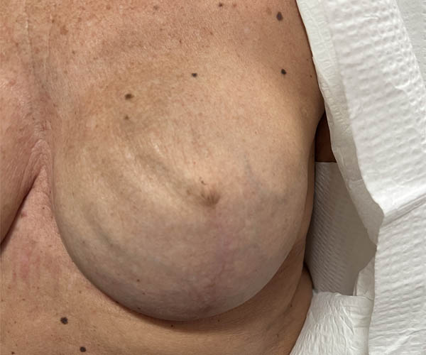 Nipple-Areola Complex (NAC) case #10099