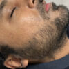 Scar/Skin Discoloration & Stretch Marks case #10159