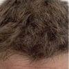 Scalp Micropigmentation case #10082