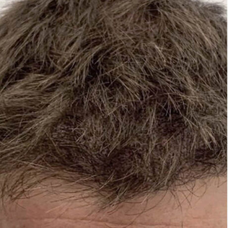 Scalp Micropigmentation case #10082