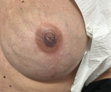 Nipple-Areola Complex (NAC) case #10099