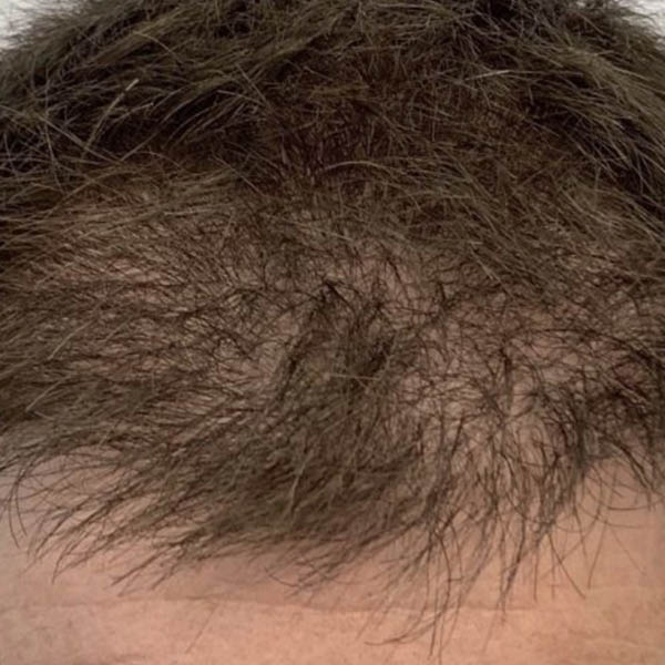 Scalp Micropigmentation case #10082