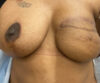 Nipple-Areola Complex (NAC) case #10096