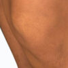 Scar/Skin Discoloration & Stretch Marks case #10162