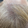 Scalp Micropigmentation case #10085