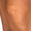 Scar/Skin Discoloration & Stretch Marks case #10162