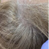 Scalp Micropigmentation case #10085