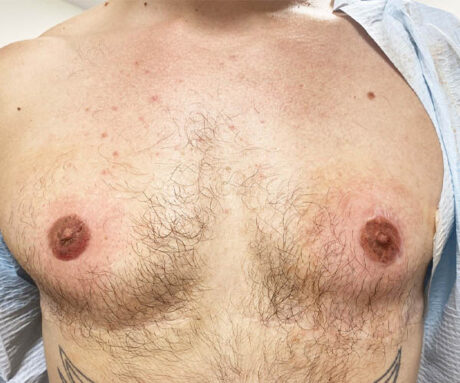 Nipple-Areola Complex (NAC) case #10093