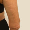 Scar/Skin Discoloration & Stretch Marks case #10156