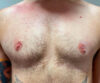Nipple-Areola Complex (NAC) case #10093