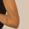 Scar/Skin Discoloration & Stretch Marks case #10156
